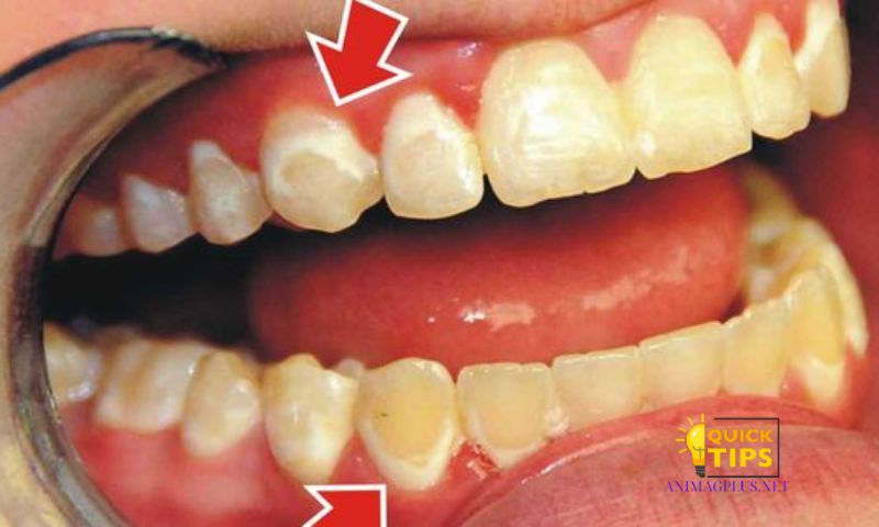 Definition of Yellow Teeth